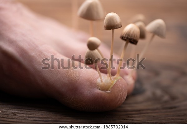 Fungi grow from the nail plates on the foot.\
Concept of nail fungus, skin and nail infections. Foot with fungus\
close-up in the background\
light.