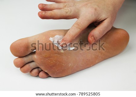Fungus of foot close-up, isolated on white background. The concept dermatology, treatment fungal and fungal infections in humans. Macro video human feet. To smear a leg with antifungal ointment