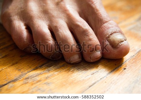 Fungus infection dry crusted feet toes nails yellow ugly disgusting