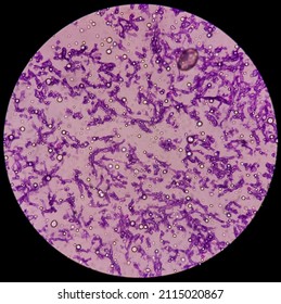Fungus Infection of Lung, Microscopic image: A Hematoxylin and Eosin stain reveals fungal hyphae of histology tissue block specimen.