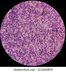 Fungus Infection Of Lung, Microscopic Image: A Hematoxylin And Eosin Stain Reveals Fungal Hyphae Of Histology Tissue Block Specimen.