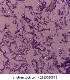 Fungus Infection Of Lung, Microscopic Image: A Hematoxylin And Eosin Stain Reveals Fungal Hyphae Of Histology Tissue Block Specimen.