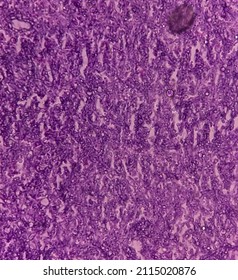 Fungus Infection Of Lung, Microscopic Image: A Hematoxylin And Eosin Stain Reveals Fungal Hyphae Of Histology Tissue Block Specimen.