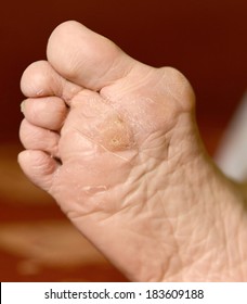 Fungus Infection On Man's Foot. Callus And Hyperkeratosis On Feet