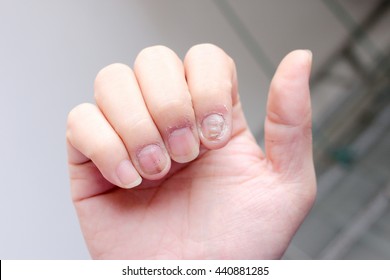 Fungus Infection On Nails Hand Finger Stock Photo 440881285 | Shutterstock