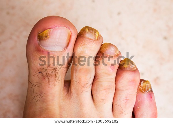 Fungus infection on\
nails of man\'s foot.