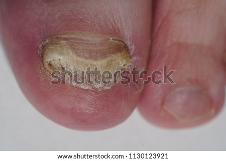 Fungus infection on toenails of male's foot close-up. Onychomycosis