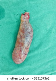 Gall Bladder After Laparoscopic Cholecystectomy Surgery