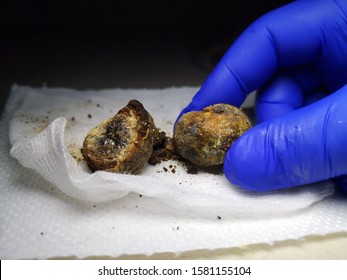 Gallstones Close Up. Calculi In The Hands Of The Surgeon After Laparoscopy, Surgery To Remove The Gallbladder. Complications Of Gallstone Disease. Cut Bile Crystals. Mobile Photo