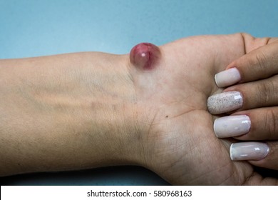 Ganglion Cyst