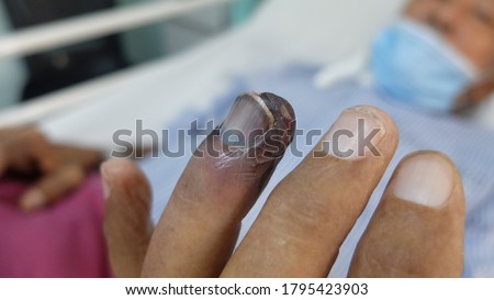 Gangrene fingers due to Brachial Artery Occlusion.