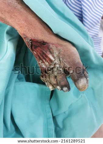 Gangrene foot due to Ischaemia Limb with underlying diabetes.