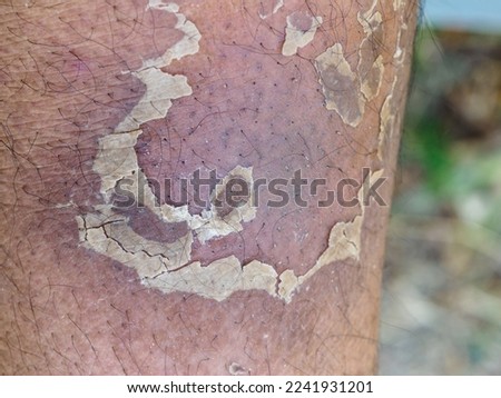  Gangrene and skin dryness.leg after cast removal.