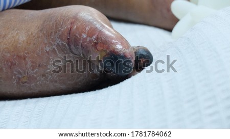 Gangrene toe due to septic emboli with underlying diabetes mellitus. Soft focus with bokeh background. 