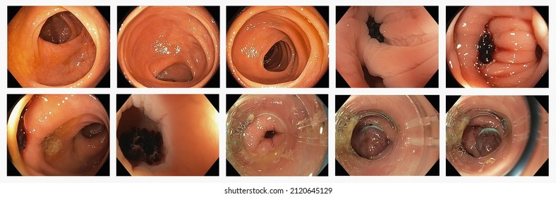 Gastrointestinal Endoscopic Image Of Colonoscopy Through Rectum Colon And Terinal Ileum To Stop Bleeding In Diverticulum With Band Ligation