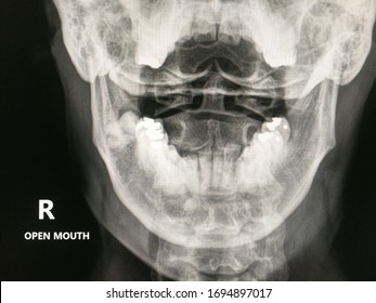 General x-ray of C-spines open mouth view shows C-spine level C1-C2 is normal.

