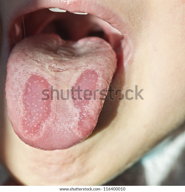 幼い子どもの舌の地理的な病気 の写真素材 今すぐ編集