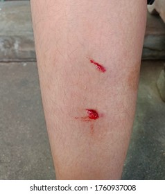 Get A Wound Due To A Dog Biting On The Leg