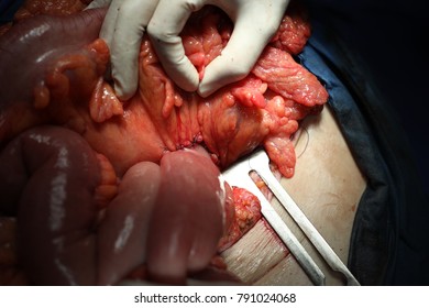 Giant Pancreatic Pseudocyst Surgery Procedure, A Cyst Jejunostomy Was Made After Cyst Drainage. 