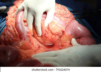 Giant Pancreatic Pseudocyst Surgery Procedure, A Cyst Jejunostomy Was Made After Cyst Drainage. 