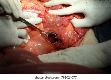 Giant Pancreatic Pseudocyst Surgery Procedure, A Cyst Jejunostomy Was Made After Cyst Drainage. 