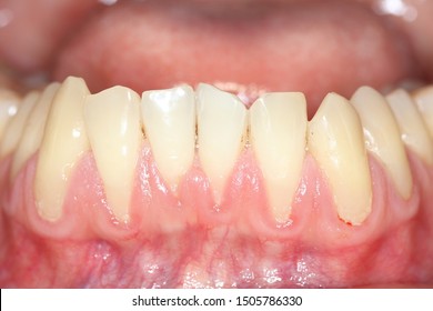 Gingival recession, also known as receding gums, is the exposure in the roots of the teeth caused by a loss of gum tissue and/or retraction of the gingival margin from the crown of the teeth. - Shutterstock ID 1505786330