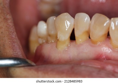 Gingival recession, also known as receding gums, is the exposure in the roots of the teeth caused by a loss of gum tissue and retraction of the gingival margin from the crown of the teeth. - Shutterstock ID 2128485983