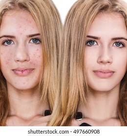 Girl With Acne Before And After Treatment