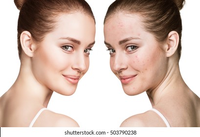 Girl With Acne Before And After Treatment