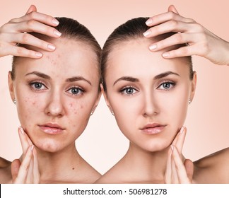 Girl With Acne Before And After Treatment