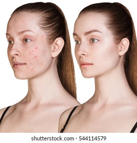 Girl With Acne Before And After Treatment.
