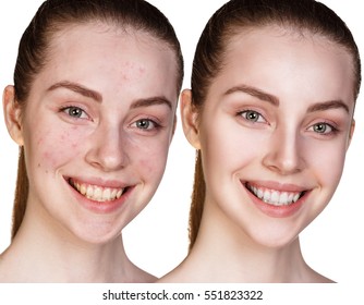 Girl with acne before and after treatment.