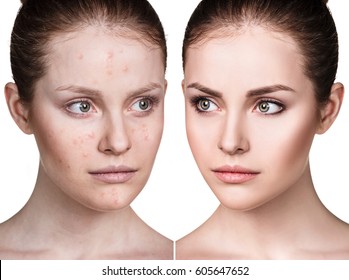 Girl With Acne Before And After Treatment.