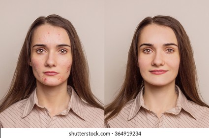 Girl With Acne On The Face - A Problem Skin