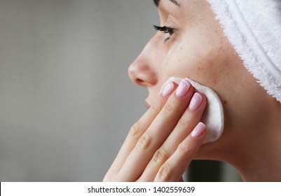 Girl With Acne On Face Rubs Face Tonic