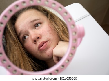 Girl with acne on the face.The girl is worried about acne on her face. The girl suffers from acne on her face. Girl with problem skin. Acne on the face.