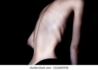 Anorexia Hd