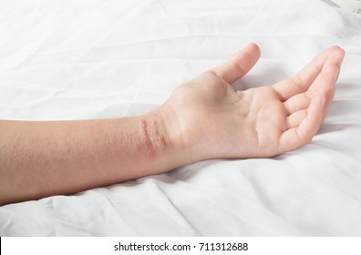  Girl Arm With Poison Ivy Rash On  White Background