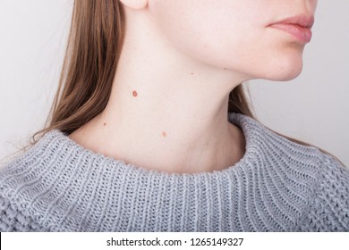 Girl with birthmarks on the neck
