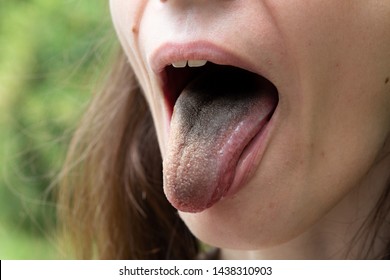 A Girl With A Black Furry Tongue Is Viewed Closeup. Symptoms Of Enterobacter Cloacae Bacteria Infection. Copy Space On The Left.