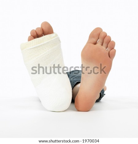 girl with a broken leg (close-up of feet, one with a plaster bandage)