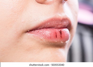 Girl With Chapped Lips