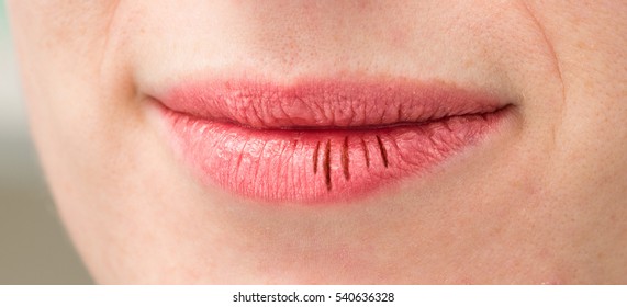 Girl With Chapped Lips