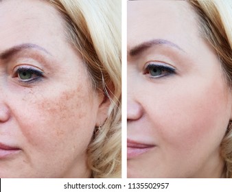 girl face wrinkles before and after, pigmentation - Shutterstock ID 1135502957
