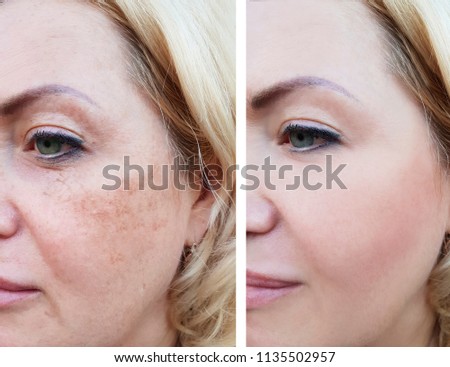 girl face wrinkles before and after, pigmentation
