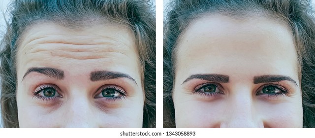 Girl Forehead Wrinkles Before And After Procedures