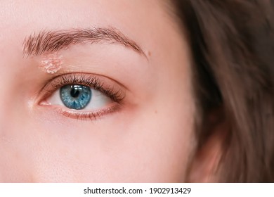 Girl Have Psoriasis On The Eye. Woman Atopic Dermatitis On Face. Skin Diseases Around Brows.