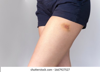 Girl Hit A Bruise On Her Leg