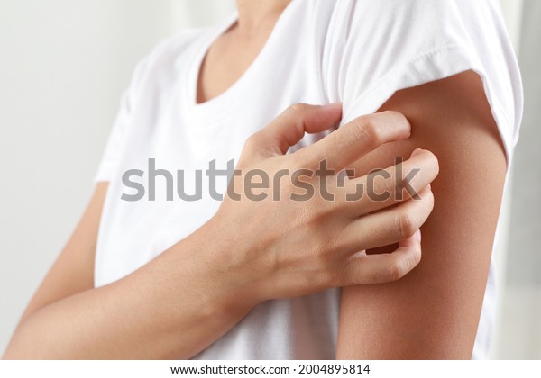 Girl itching on skin caused by fungus,\
dermatitis, drug allergy, food allergy,\
allergy.