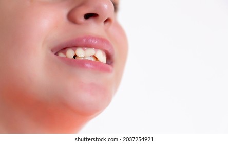 The Girl Knocked Out Two Front Teeth. Teeth Augmentation.